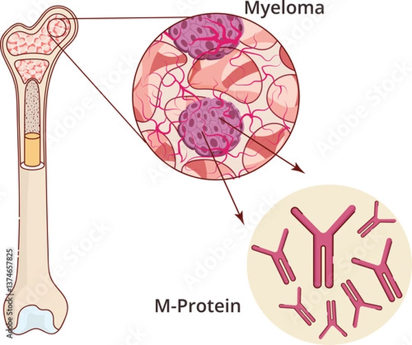 Obraz Myeloma pathology illustration. Illustration of a bone marrow with cancer producing M-protein