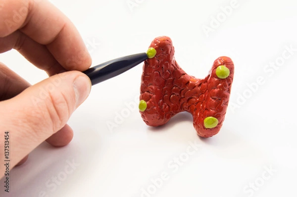 Fototapeta Parathyroid gland. Doctor or teacher of medical University or school points to anatomical location of parathyroid glands in model of thyroid gland. Concept for parathyroid diagnostics or treatment  