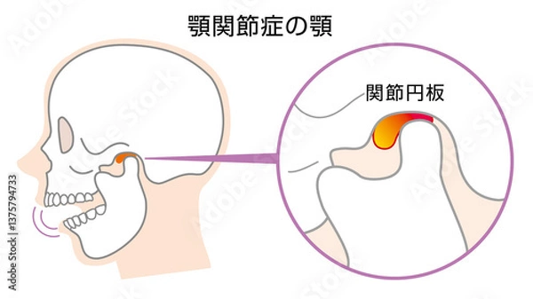 Obraz 顎関節症の顎の説明イラスト　