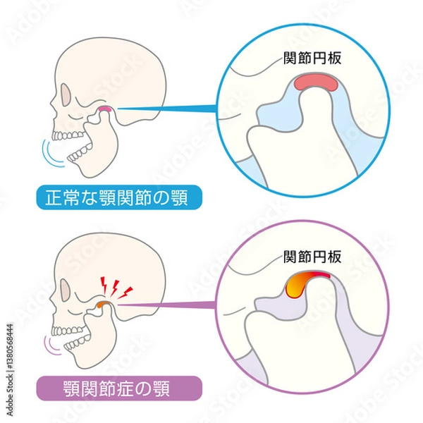 Obraz 顎関節症の症状と説明のイラスト