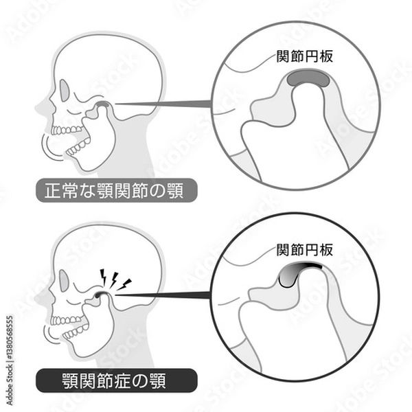 Obraz 顎関節症の症状と説明のイラスト　モノトーン
