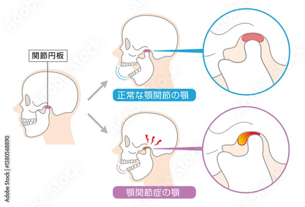 Obraz 顎関節症の症状と説明のイラスト