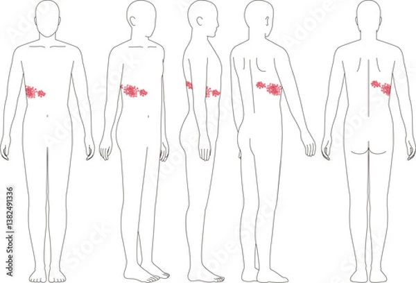 Obraz 帯状疱疹の症状。正面から側面背面の人間のイラスト