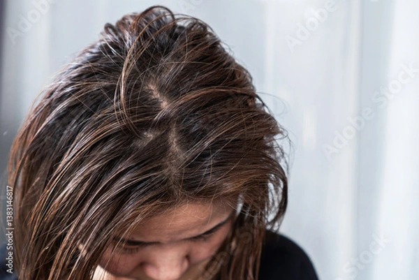 Obraz asian woman with oily scalp and thinning hair, feeling uncomfortable with greasy roots and hair loss, possibly caused by scalp problems like dandruff, eczema, or too much oil production