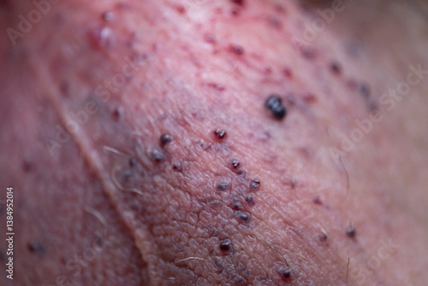 Fototapeta Angiokeratomas of the scrotum (Fordyce angiokeratomas), red-to-violaceous papules composed of dilated dermal capillariesrated image