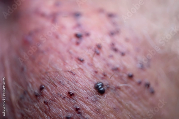 Fototapeta Angiokeratomas of the scrotum (Fordyce angiokeratomas), red-to-violaceous papules composed of dilated dermal capillaries