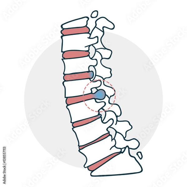 Fototapeta Herniated intervertebral disc icon