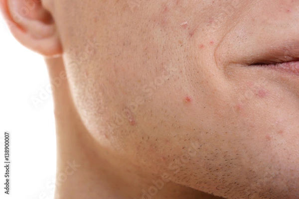 Fototapeta Face of handsome young man with problem skin, closeup
