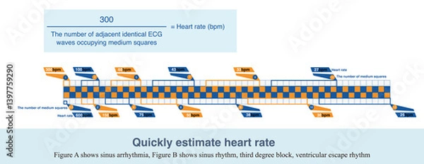 Fototapeta On ECG paper, five small squares make up a middle square. Divide 300 by the number of middle squares occupied by adjacent identical ECG waves to get the heart rate.
