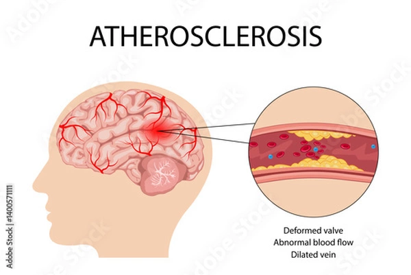 Fototapeta Anatomy of a person with atherosclerotic stroke. Atherosclerosis of the blood vessels of the brain