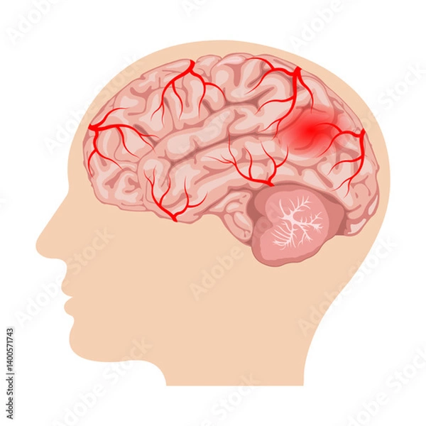 Fototapeta hemorrhagic stroke. intracerebral and subarachnoid hemorrhage. human brain with blood vessels and hematoma