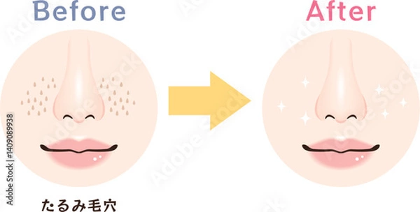 Fototapeta 鼻の毛穴トラブル　ビフォーアフター｜たるみ毛穴