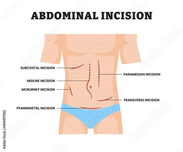 Obraz Abdominal Incision for man, educational medical poster design healthcare scheme, labeled Surgical Cut in Abdomen for Medical Procedure, Anatomy, Laparotomy, Surgery Education