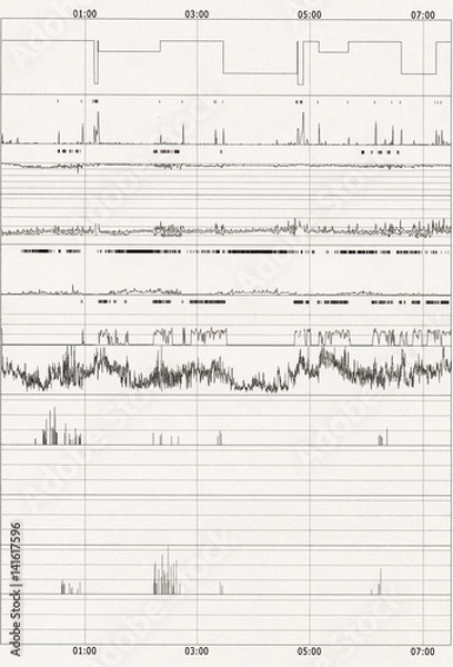 Obraz polysomnography (PSG) sleep study