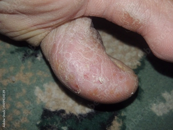 Fototapeta Close-Up of a Dry and Cracked Skin Condition on a Toe
