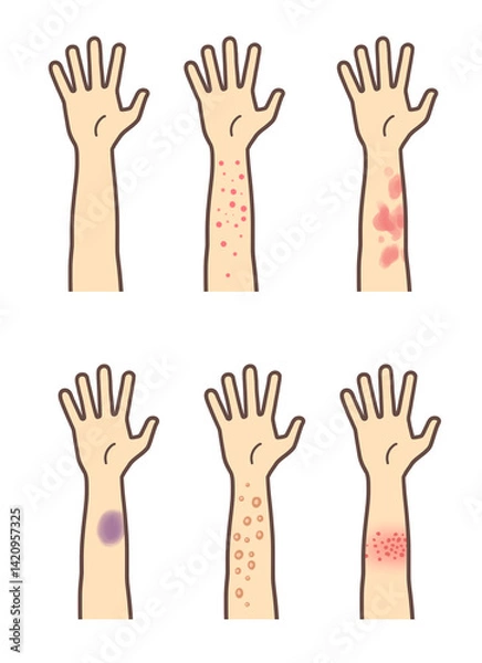 Obraz 帯状疱疹や湿疹、膿疱、アザができた腕のセット