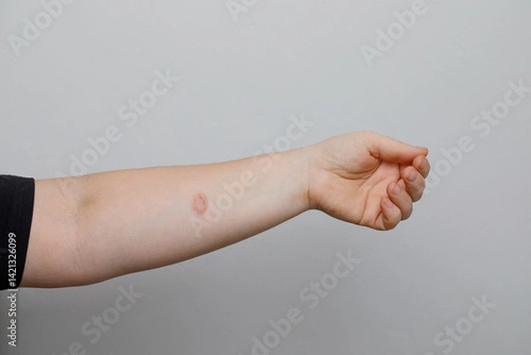 Fototapeta Hand with rash. Red psoriatic eruptions or inflamed eczema. Allergic urticaria problems and infectious