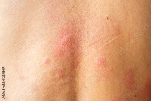 Obraz Young asian man itching and scratching on his back from allergic itchy dry skin eczema dermatitis insect bites