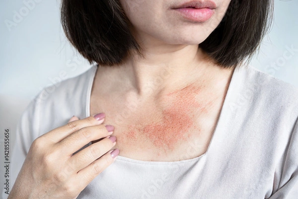 Obraz close-up of a woman with a rash and red, irritated skin on her neck, feeling itchy due to sensitive skin conditions like dryness, eczema, allergic reactions, or sweat from hot weather