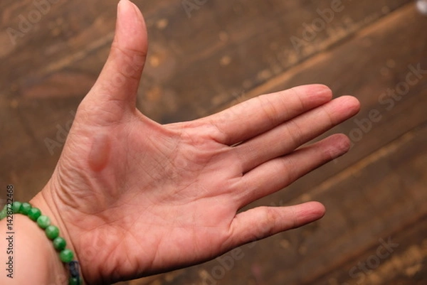 Fototapeta burns on the palms. blistered palms.