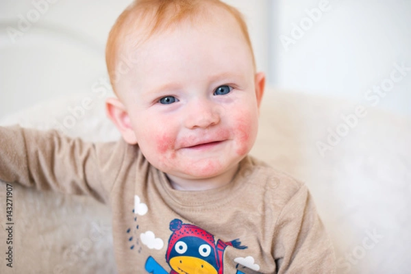 Obraz Red-haired boy with atopic dermatitis