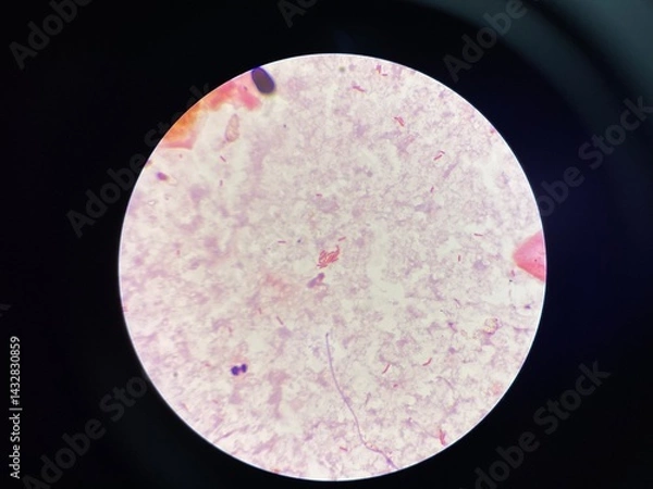 Fototapeta gram negative bacilli in hemoculture.