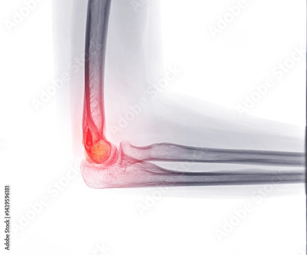 Fototapeta X-ray showing an elbow joint post-surgery with a fixation screw in place, highlighting the fracture site and inflammation in red.