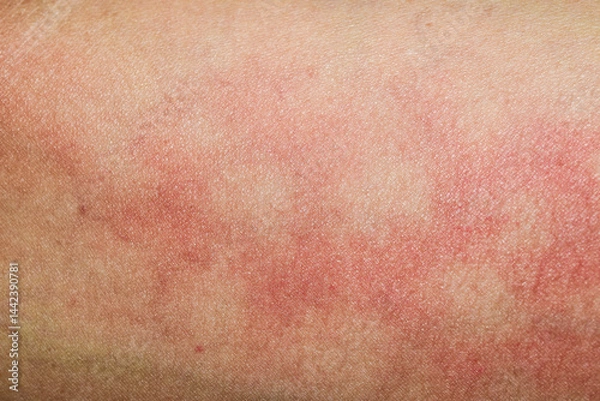 Fototapeta Human skin background texture dermatitis rash