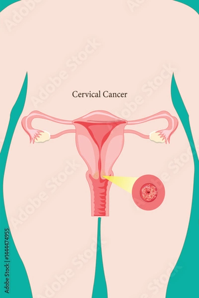 Obraz Diagram showing cervical cancer in uterus with zoomed detail of affected cervical area