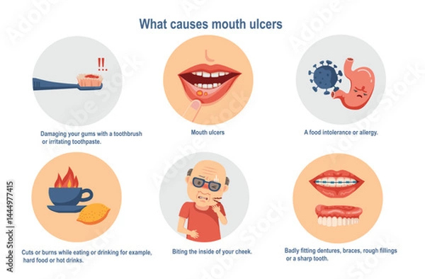 Fototapeta what causes mouth ulcers