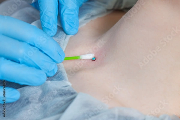 Obraz Operation to install microdermal piercing