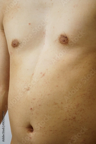 Obraz お腹　じんましん　湿疹