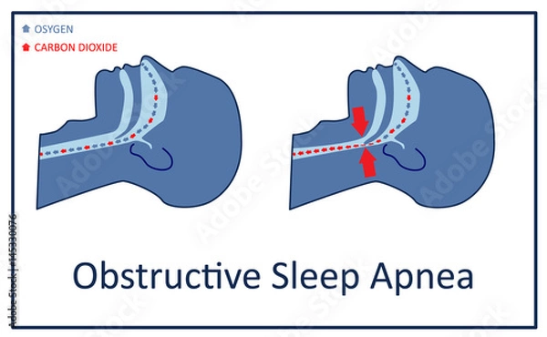 Obraz Vector illustration of obstructive sleep apnea.