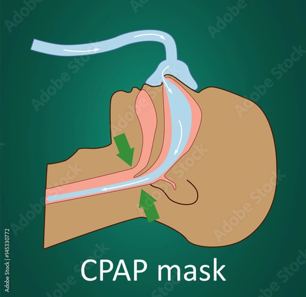 Obraz Vector illustration of normal breathing with CPAP mask. 