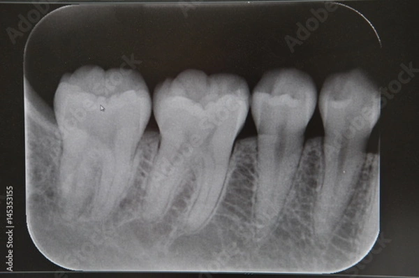 Obraz 歯のレントゲン写真