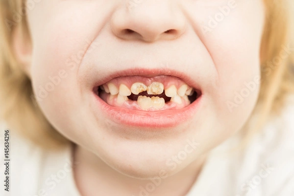 Obraz Child blonde showing bad teeth