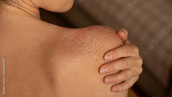 Obraz skin peeling on woman's shoulders, sunburn, pain, unhealthy, uv