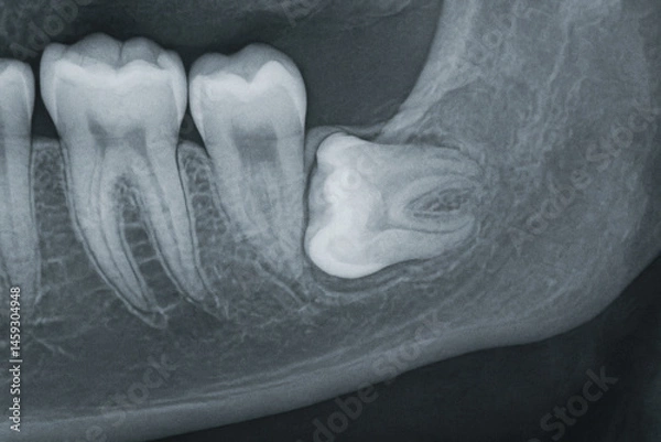 Obraz Impacted wisdom teeth for x-ray vision