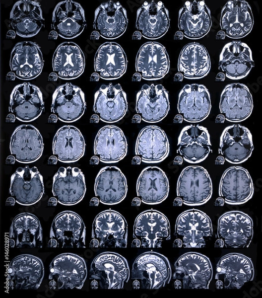 Obraz MRI scan or magnetic resonance image of head and brain scan. Close up view