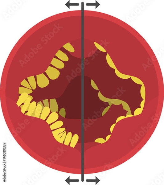 Obraz Normal and damaged small intestine. Celiac disease.