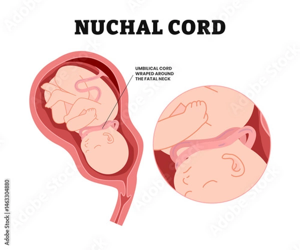Obraz Baby Nuchal Cord, educational medical poster design healthcare, labeled wrapped umbilical cord around fetus neck, c section baby birth fetal neck death Knot test born labor fluid Anemia womb fetus.