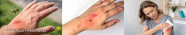 Fototapeta Bee sting injury treatment on a hand in a home setting  