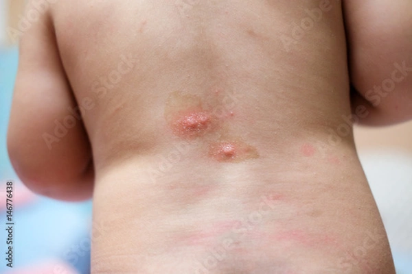 Fototapeta Baby's back with red spot , Blister caused by insect bite