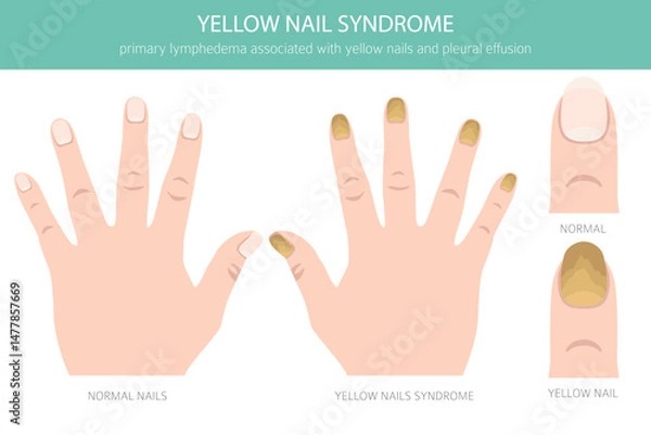 Fototapeta Yellow Nail Syndrome is a rare condition marked by thick, slow-growing yellow nails, often with lymphedema and respiratory issues. Medical infographic. Vector illustration