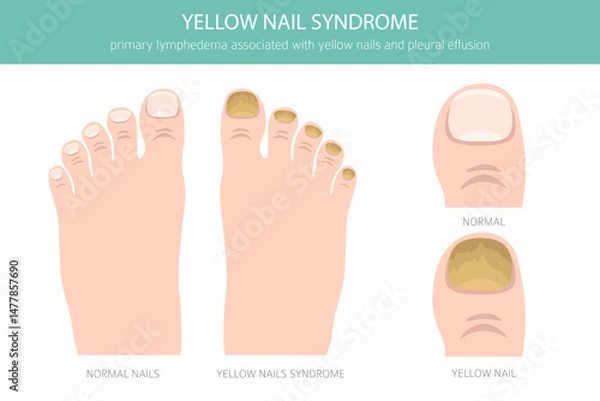 Fototapeta Yellow Nail Syndrome is a rare condition marked by thick, slow-growing yellow nails, often with lymphedema and respiratory issues. Medical infographic. Vector illustration