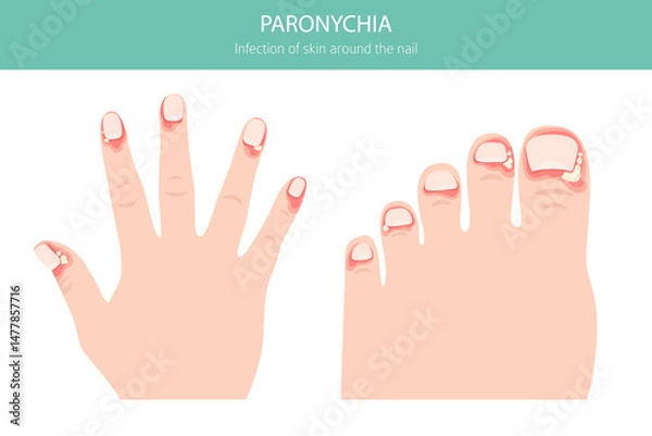 Fototapeta Paronychia is an infection of the nail fold causing redness, swelling, and pain. Often linked to bacteria, trauma, or moisture exposure. Medical infographic design. Vector illustration