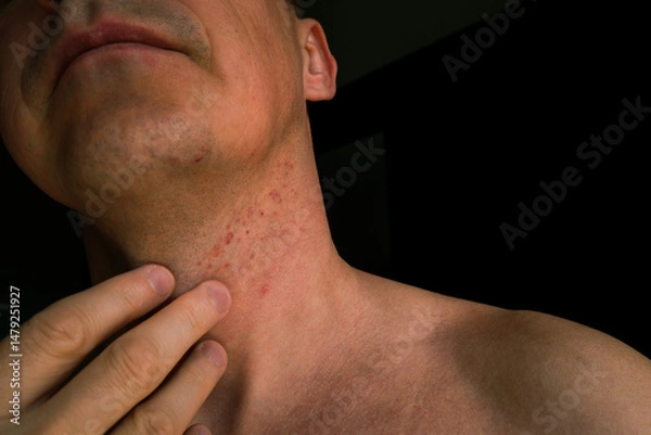 Obraz Skin irritation after shaving. Skin irritation on male neck after shaving. Close-up photo.