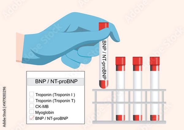 Fototapeta BNP and NT-proBNP are useful markers for diagnosing and monitoring heart failure.