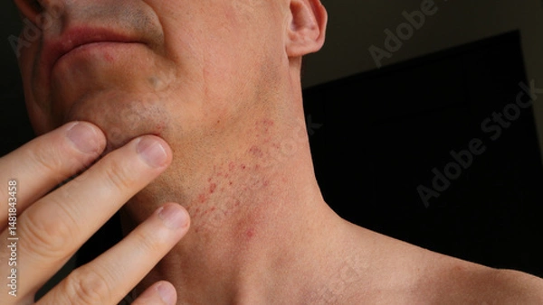Obraz Skin irritation after shaving. Skin irritation on male neck after shaving. Close-up photo.