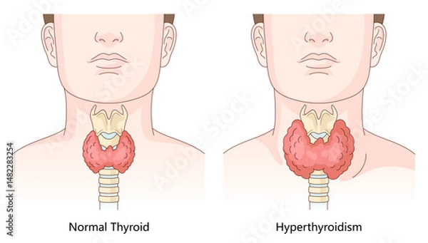 Fototapeta difference between a healthy thyroid gland and an enlarged thyroid affected by hyperthyroidism for educational use diagram hand drawn schematic vector illustration. Medical science educational.
